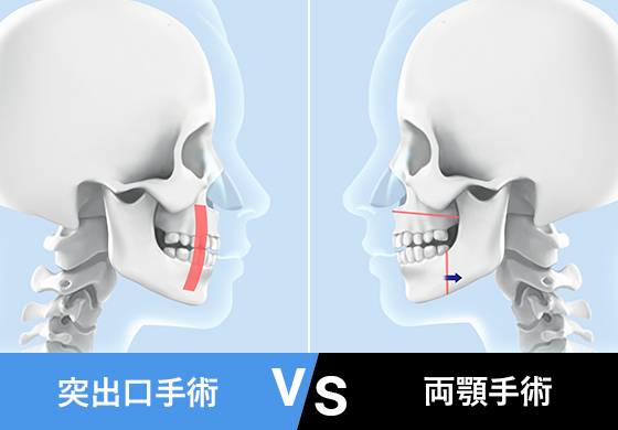 突出口手術 VS 양악수술
