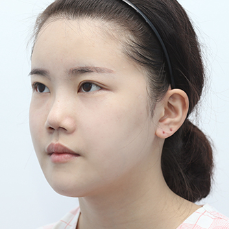 四角顎手術