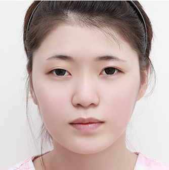 頬骨手術