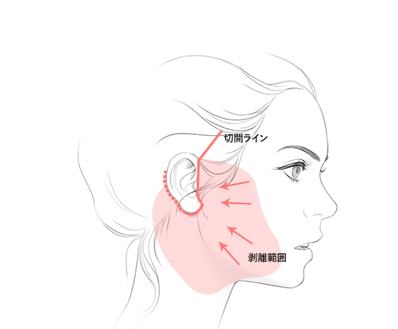 절개라인