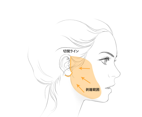 절개라인