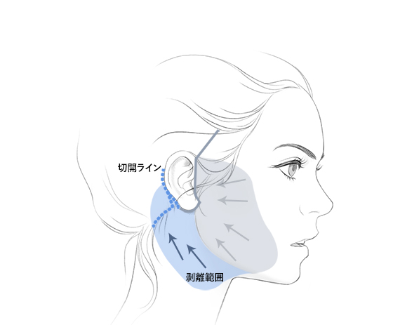 절개라인